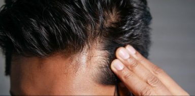 fibromyalgia and hair loss